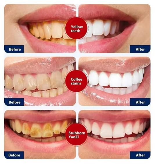 whitening toothpaste for smokers, toothpaste for smoke stains India, anti-stain toothpaste India, best toothpaste for coffee stains, tobacco stain removal toothpaste, white plus toothpaste India, teeth whitening toothpaste India, stain removal toothpaste for smokers, toothpaste for yellow teeth India, strong whitening toothpaste