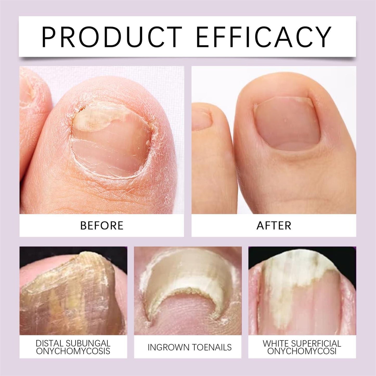 anti discoloration nail serum, nail treatment India, nail serum for brittle nails, natural nail solution, nail care oil, bee venom cosmetic serum,