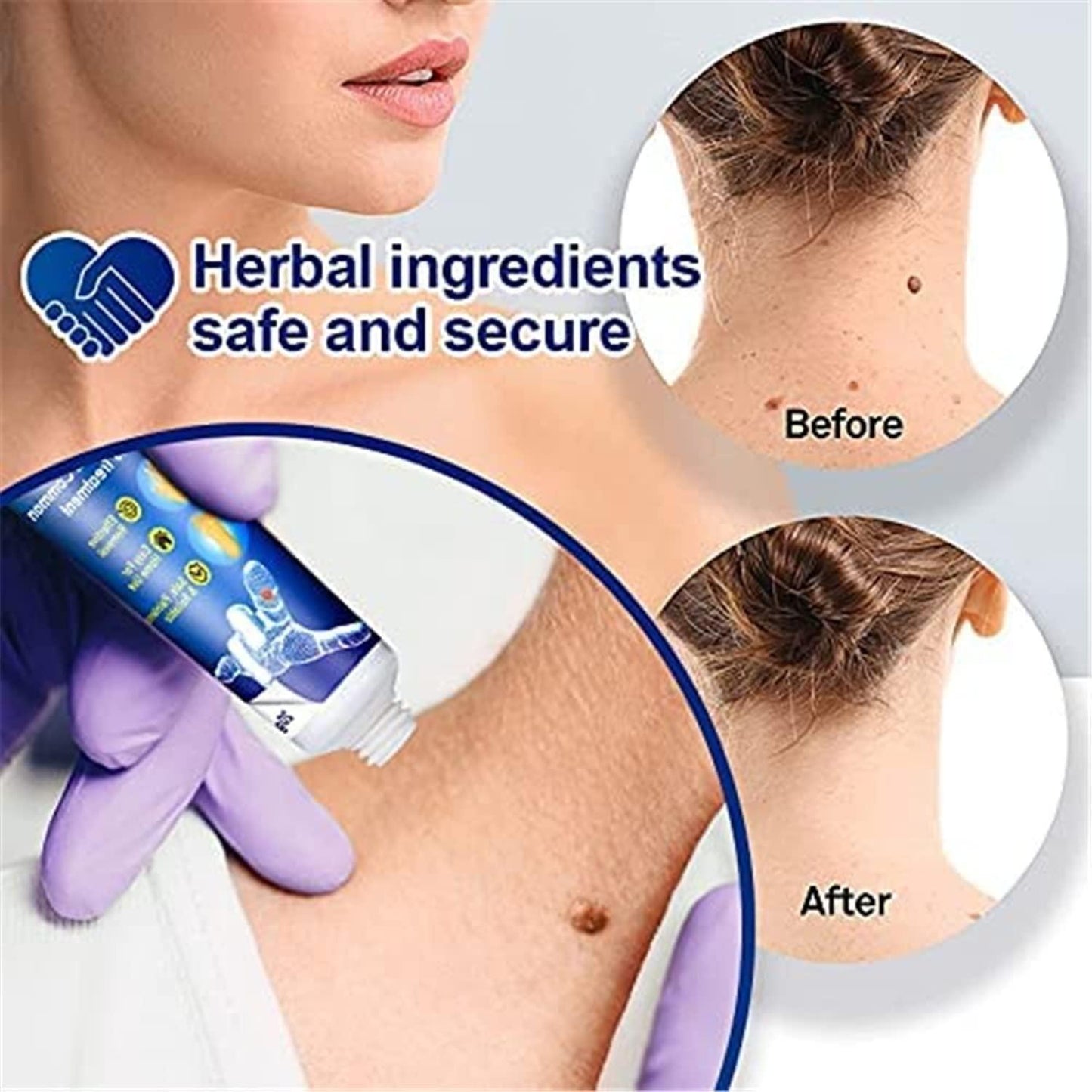 wart and mole remover cream India, skin tag remover cream pain-free, blemish cream for moles and warts, buy 1 get 1 free WartsOff cream, instant mole and wart removal cream, WartsOff cream for skin tag removal, pain-free blemish cream for face and body, WartsOff wart remover cream India, skin tag removal solution WartsOff